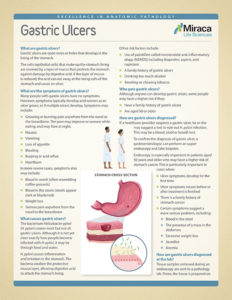 gastric ulcer illustration