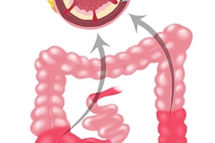 crohns web