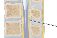 epidural-web