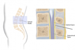 epidural_label_orientation-web