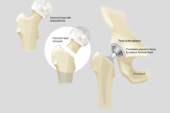 hip_arthroplasty_50png